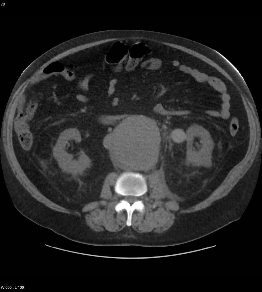 Abdominal aortic aneurysm with intramural hematoma then rupture (Radiopaedia 50278-55631 Axial non-contrast 75).jpg