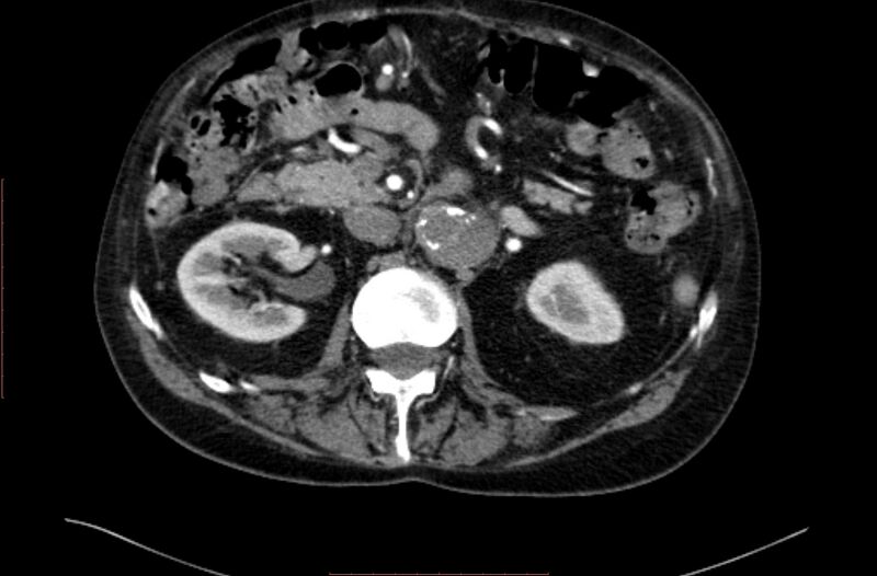 File:Abdominal aortic interposition tube graft and aneurysm thrombosis (Radiopaedia 71438-81857 Axial C+ arterial phase 50).jpg