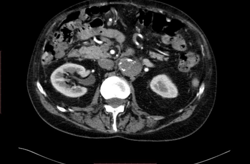 Abdominal aortic interposition tube graft and aneurysm thrombosis (Radiopaedia 71438-81857 Axial C+ arterial phase 50).jpg