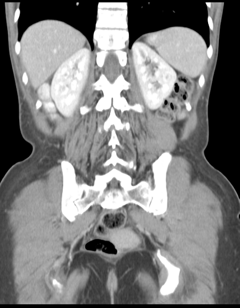 File:Abdominal desmoid tumor (Radiopaedia 41007-43740 Coronal C+ portal venous phase 31).png