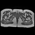 Abdominal wall endometriosis (Radiopaedia 83702-98847 Axial T1 20).jpg