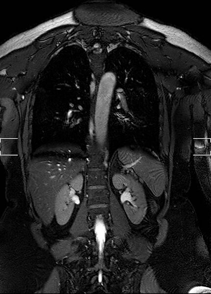 File:Aberrant right subclavian artery with background Takayasu arteritis (Radiopaedia 21423-21363 Coronal MRA 24).jpg