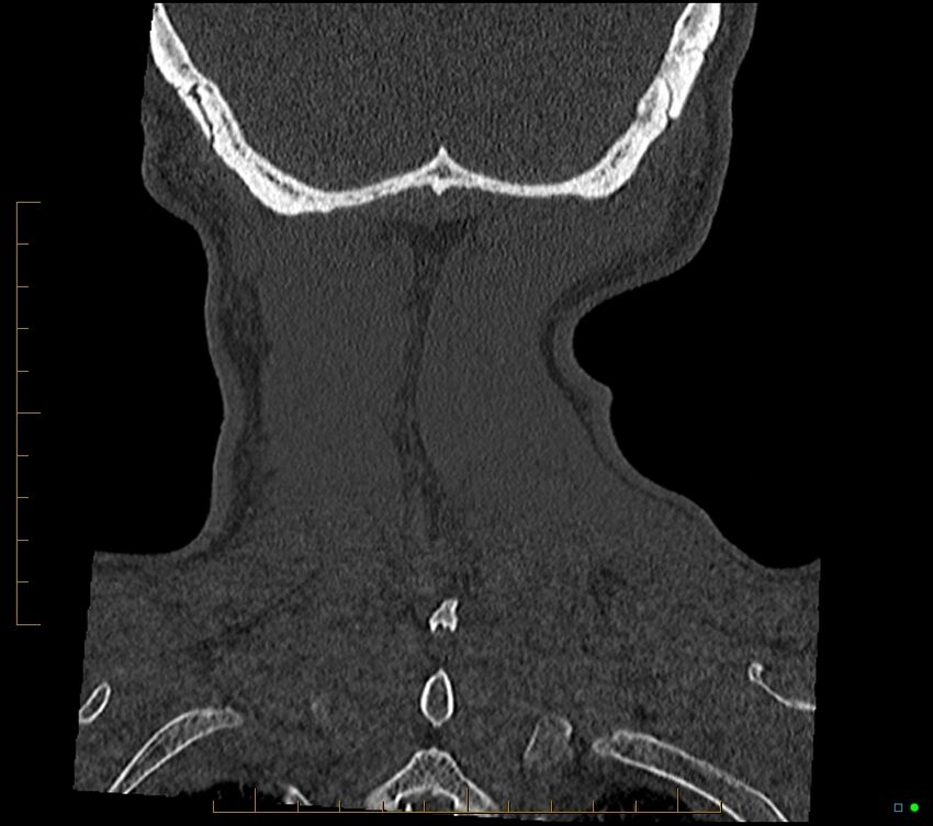 Accessory articulation of cervical transverse processes (Radiopaedia 82715-96933 Coronal non-contrast 105).jpg
