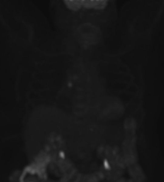 File:Accumulation of FDG in central venous catheter mimicking lymph node metastasis (Radiopaedia 63301-71878 Coronal PET 1).PNG