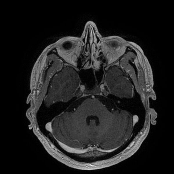 File:Acoustic schwannoma - intracanalicular (Radiopaedia 37247-39024 Axial T1 C+ 73).jpg