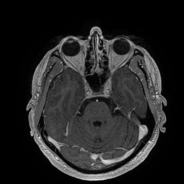 File:Acoustic schwannoma - intracanalicular (Radiopaedia 37247-39024 Axial T1 C+ 84).jpg