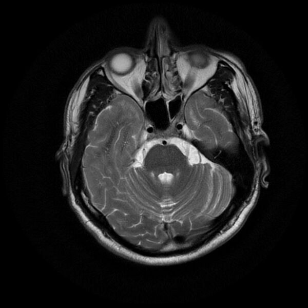 File:Acoustic schwannoma - intracanalicular (Radiopaedia 37247-39024 Axial T2 7).jpg