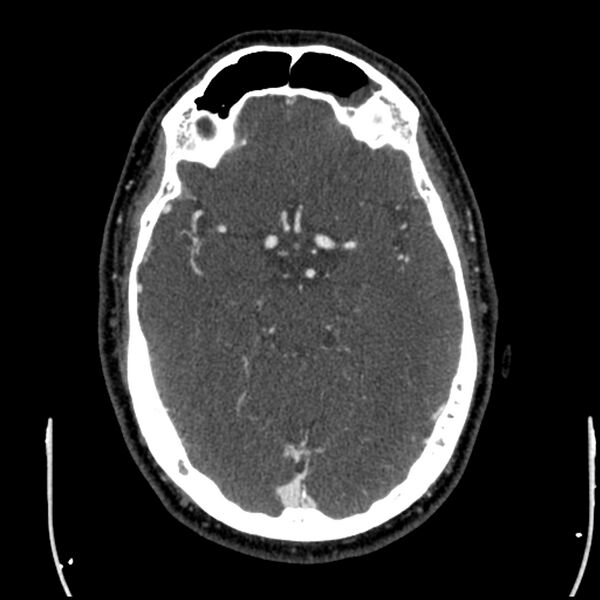 File:Acute A3 occlusion with ACA ischemic penumbra (CT perfusion) (Radiopaedia 72036-82527 Axial C+ arterial phase thins 104).jpg