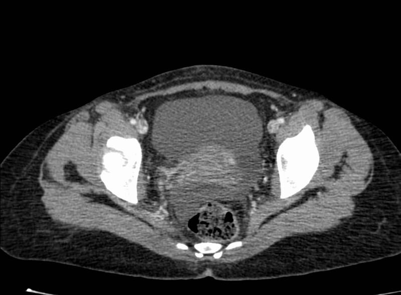 File:Acute Budd-Chiari syndrome (Radiopaedia 60858-68638 Axial C+ portal venous phase 271).jpg