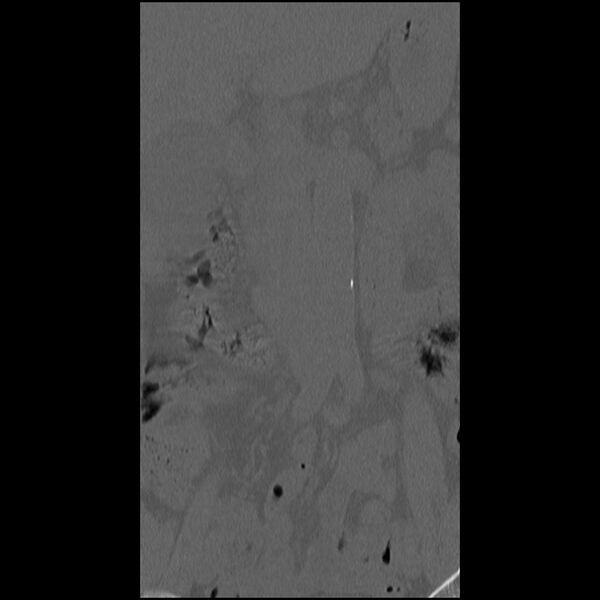 File:Acute Schmorl's node (Radiopaedia 83276-102365 Coronal bone window 7).jpg