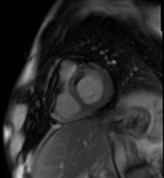 File:Acute anteroseptal myocardial infarction (Radiopaedia 68409-77945 Short axis (basal) Perfusion 24).jpg