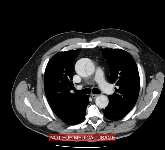 File:Acute aortic dissection - Stanford type A (Radiopaedia 40661-43285 Axial C+ portal venous phase 15).jpg