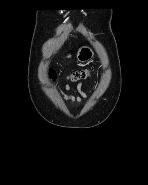 File:Acute appendicitis - large appendicoliths (Radiopaedia 61805-69820 Coronal C+ portal venous phase 18).jpg