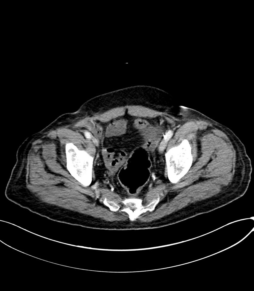 Acute arterial mesenteric ischemia (Radiopaedia 78238-90828 Axial C+ portal venous phase 124).jpg