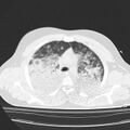 Acute aspiration pneumonitis (Radiopaedia 33605-34703 Axial lung window 34).jpg