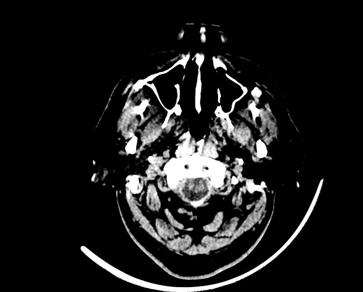 File:Acute cerebral infarct (Radiopaedia 35604-37123 Axial non-contrast 1).jpg