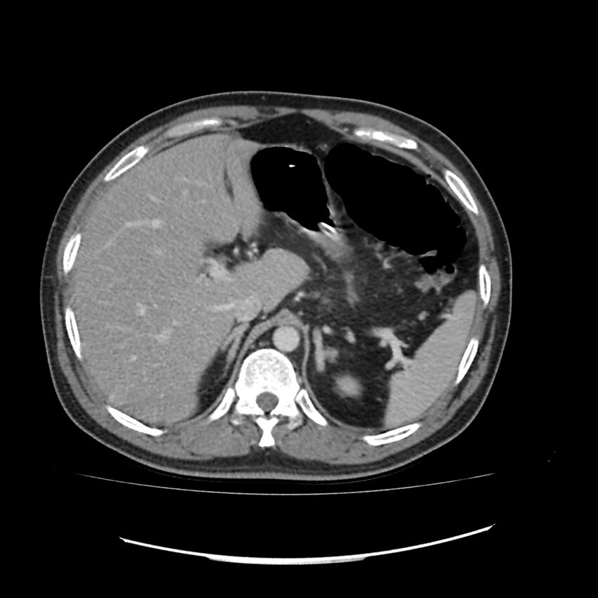 Acute mesenteric ischemia - superior mesenteric artery thrombosis (Radiopaedia 73947-84776 Axial C+ portal venous phase 9).jpg