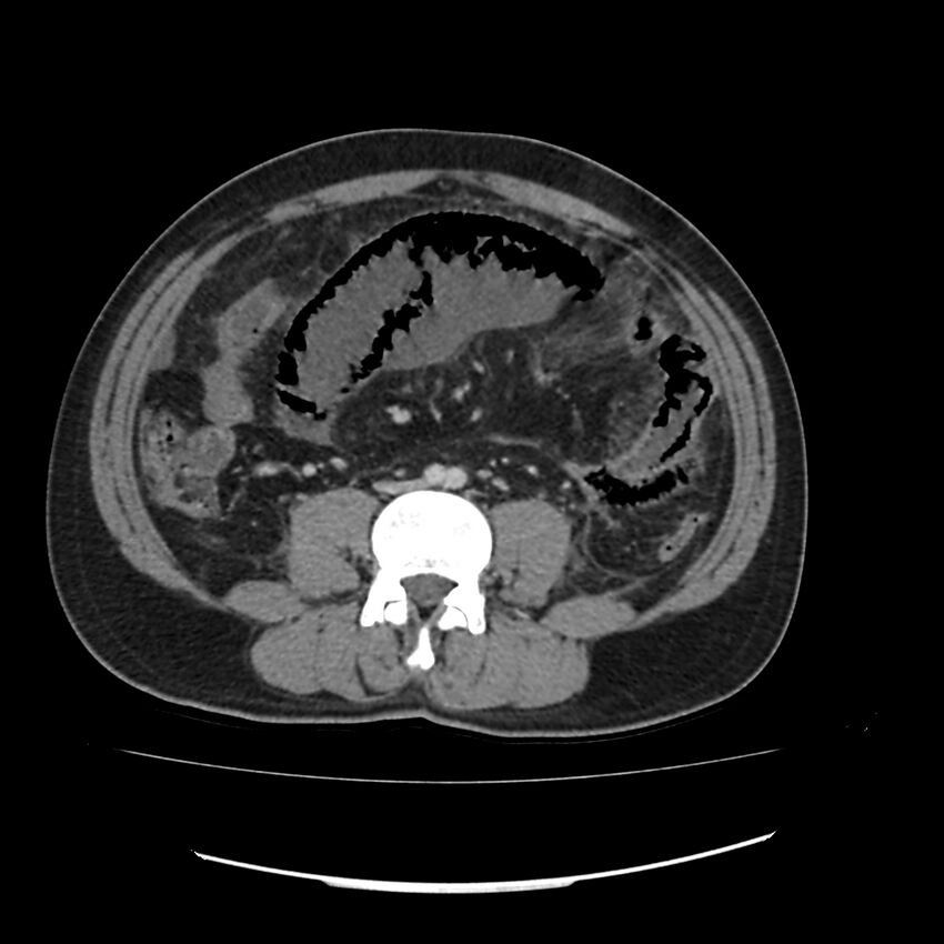 Acute mesenteric ischemia - superior mesenteric artery thrombosis (Radiopaedia 73947-84776 Axial C+ portal venous phase 91).jpg