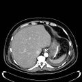 Acute pancreatic necrosis (Radiopaedia 13560-18500 Axial C+ portal venous phase 30).jpg