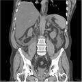 Acute pancreatitis (Radiopaedia 19135-19116 Coronal non-contrast 28).jpg