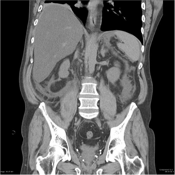 File:Acute pancreatitis (Radiopaedia 19135-19116 Coronal non-contrast 28).jpg
