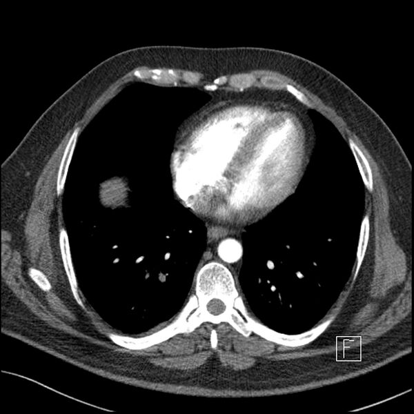 File:Acute pulmonary embolism with pulmonary infarct (Radiopaedia 73062-83768 Axial C+ CTPA 53).jpg