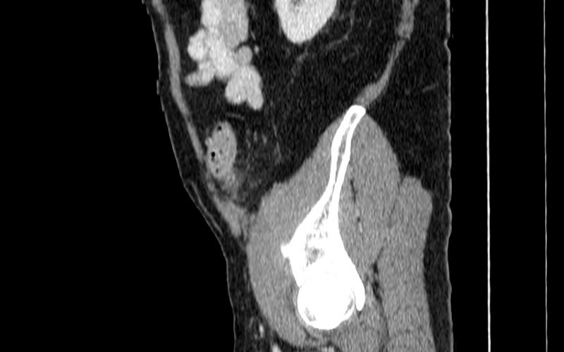 File:Acute sigmoid colon diverticulitis (Radiopaedia 55507-61976 Sagittal C+ portal venous phase 106).jpg
