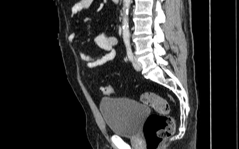 File:Acute sigmoid colon diverticulitis (Radiopaedia 55507-61976 Sagittal C+ portal venous phase 9).jpg