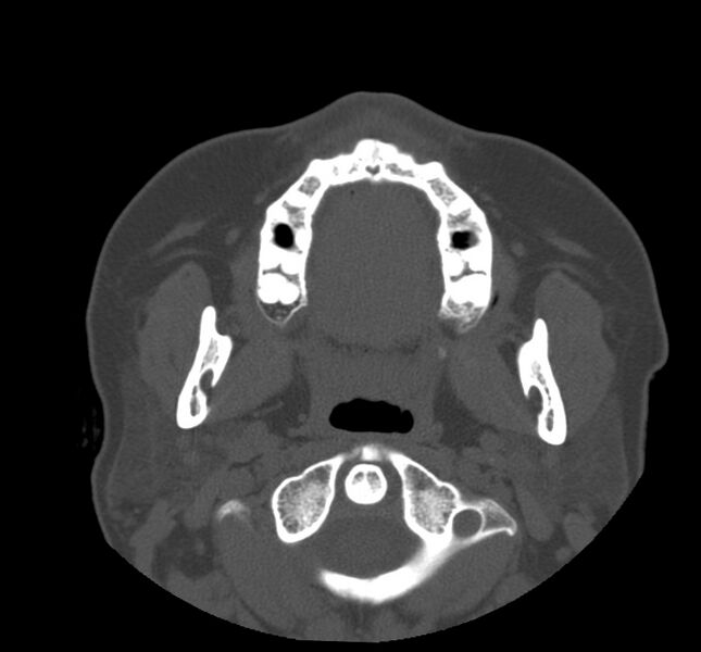 File:Acute sinusitis (Radiopaedia 22419-22455 Axial non-contrast 2).jpg