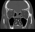Acute sinusitis (Radiopaedia 23161-23215 Coronal bone window 35).jpg