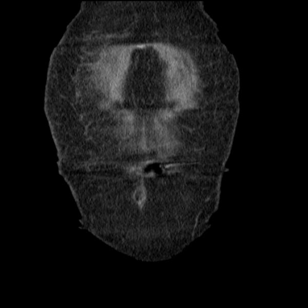 File:Acute tubular necrosis (Radiopaedia 28077-28334 D 11).jpg