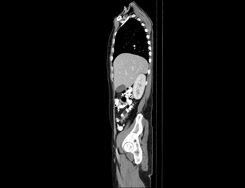 Addison disease (Radiopaedia 49318-54412 Sagittal C+ portal venous phase 51).jpg