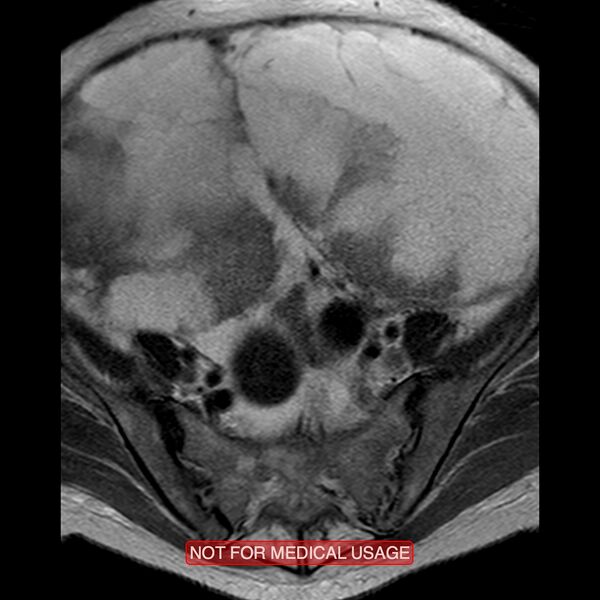 File:Adenocarcinoma of the cervix (Radiopaedia 28373-28615 Axial T2 19).jpg