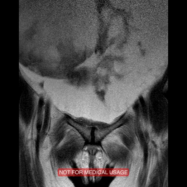 File:Adenocarcinoma of the cervix (Radiopaedia 28373-28615 Coronal T2 3).jpg
