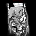 Adenocarcinoma of the colon (Radiopaedia 8191-9039 Coronal liver window 15).jpg