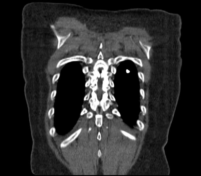 File:Adenocarcinoma of the lung (Radiopaedia 44205-47803 Coronal C+ portal venous phase 90).jpg