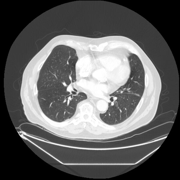 File:Adenocarcinoma of the lung (Radiopaedia 44876-48759 Axial lung window 45).jpg