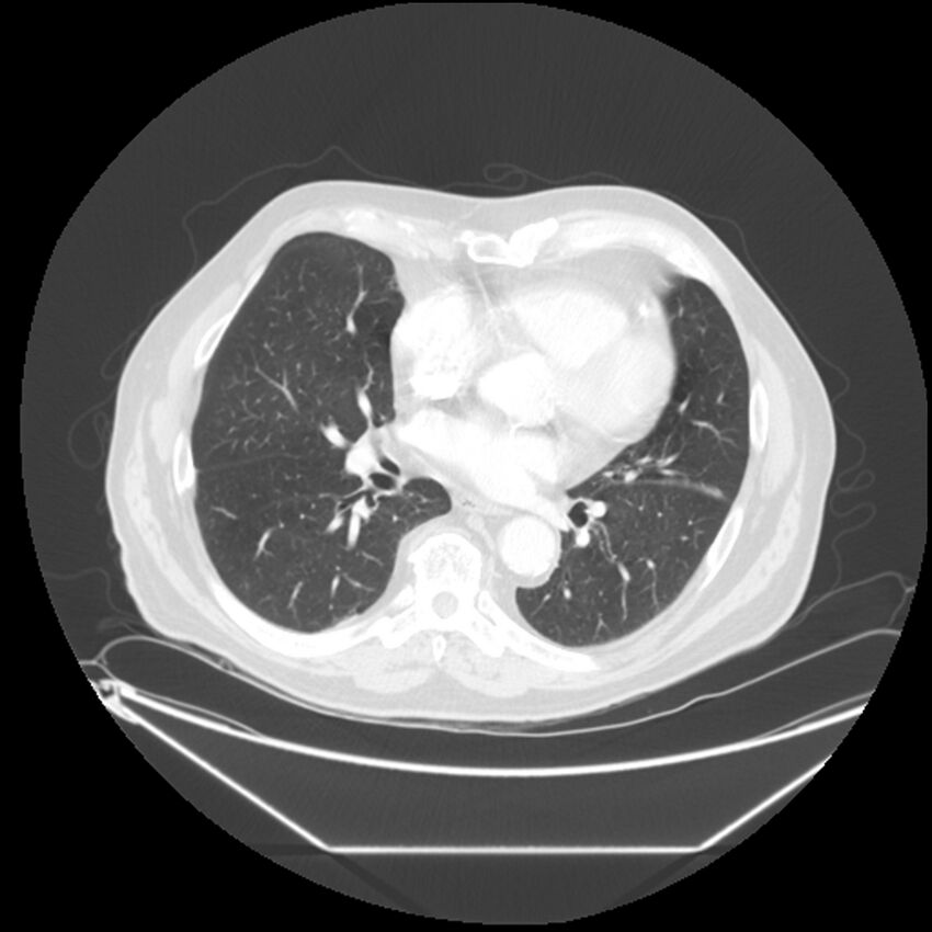 Adenocarcinoma of the lung (Radiopaedia 44876-48759 Axial lung window 45).jpg