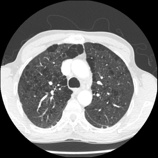 File:Adenocarcinoma of the lung - micropapillary predominant (Radiopaedia 42446-45563 C 1).jpg