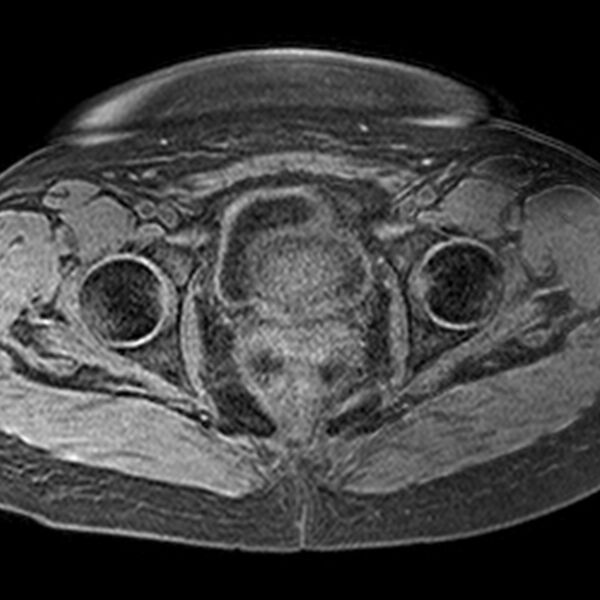 File:Adenomyoma of the uterus (Radiopaedia 9871-10439 Axial T1 fat sat 7).jpg