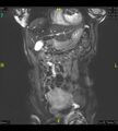Adenomyosis (Radiopaedia 43504-46889 Coronal 2D FIESTA 7).jpg