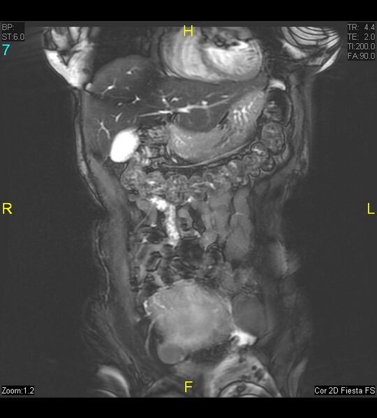 File:Adenomyosis (Radiopaedia 43504-46889 Coronal 2D FIESTA 7).jpg
