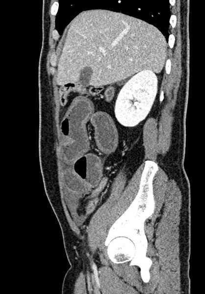 File:Adhesional small bowel obstruction (Radiopaedia 58900-66131 Sagittal C+ portal venous phase 67).jpg
