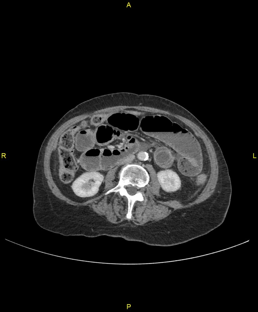Adhesional small bowel obstruction (Radiopaedia 85402-101024 Axial C+ portal venous phase 140).jpg