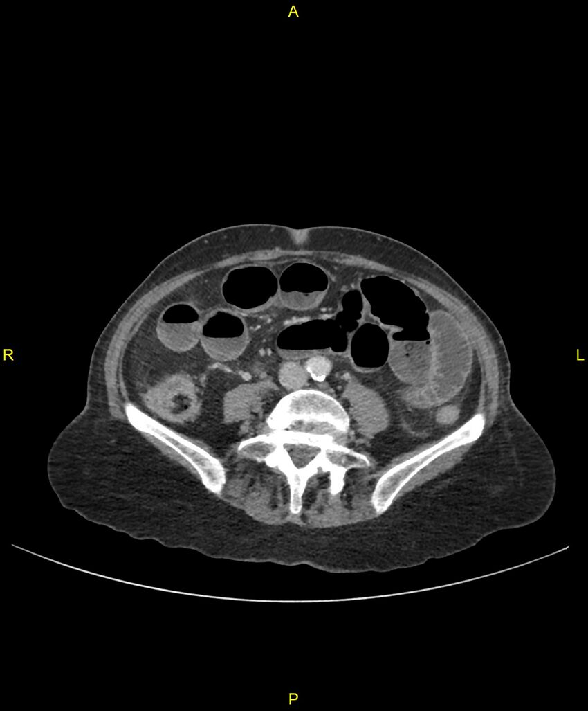 Adhesional small bowel obstruction (Radiopaedia 85402-101024 Axial C+ portal venous phase 173).jpg