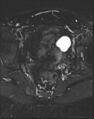 Adnexal multilocular cyst (O-RADS US 3- O-RADS MRI 3) (Radiopaedia 87426-103754 Axial T2 fat sat 15).jpg