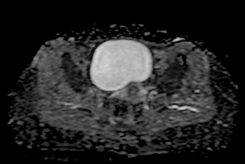 File:Adult granulosa cell tumor of the ovary (Radiopaedia 71581-81950 Axial ADC 16).jpg