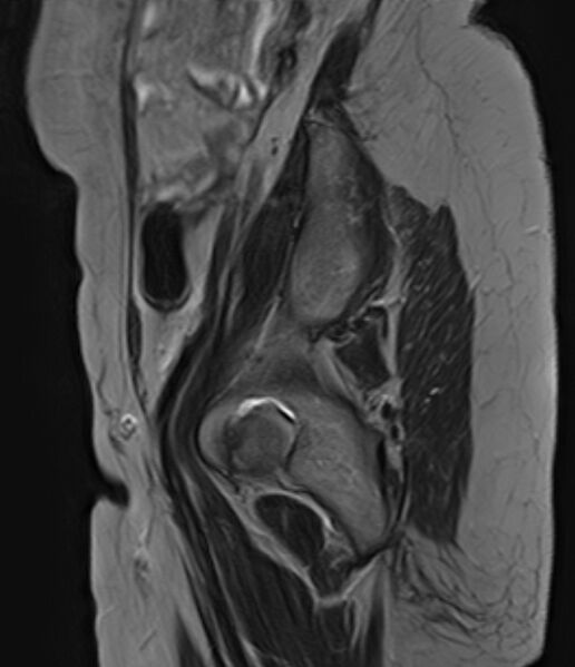 File:Adult granulosa cell tumor of the ovary (Radiopaedia 71581-81950 Sagittal T2 2).jpg