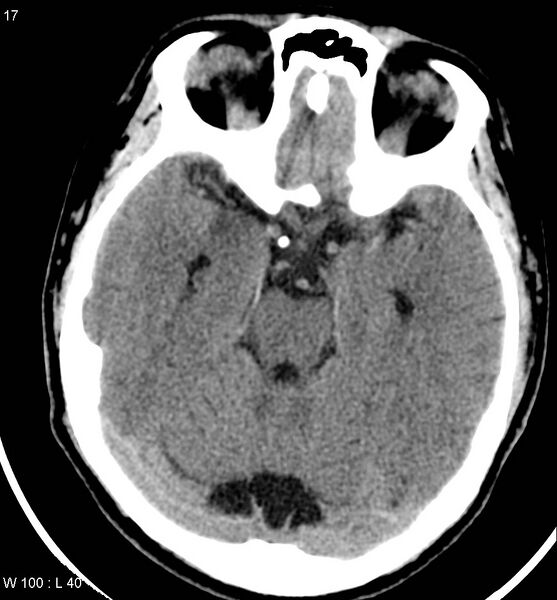 File:Aicardi syndrome (Radiopaedia 5353-7116 Axial non-contrast 14).jpg