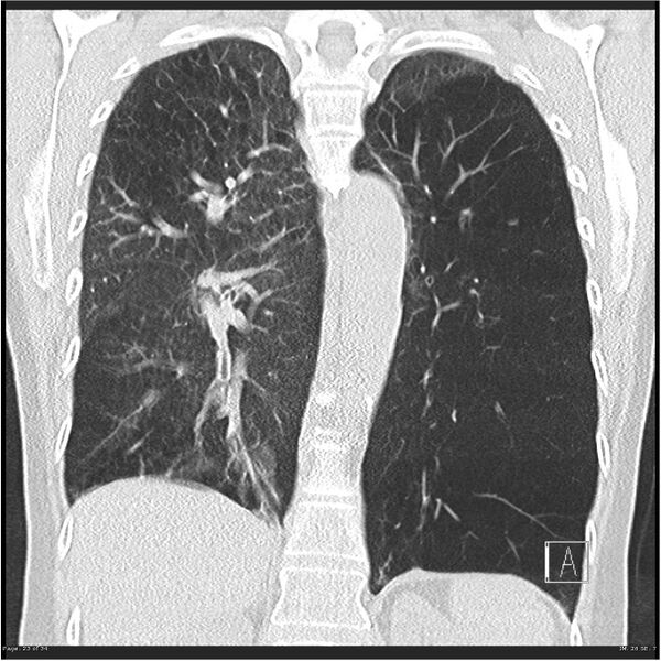 File:Alpha-1-antitrypsin deficiency (Radiopaedia 26537-26678 Coronal lung window 23).jpg